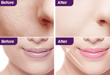 anti-aging facial - embellir before and after