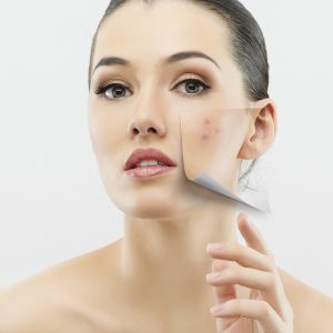 Adult Acne: 3 Effective Ways To Bid Goodbye!