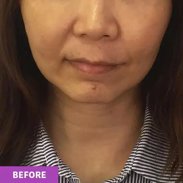 A close-up of a woman's lower face shows uneven skin texture and complexion, suggesting the need for an anti-ageing facial. The word "BEFORE" appears in a purple box in the lower left corner.