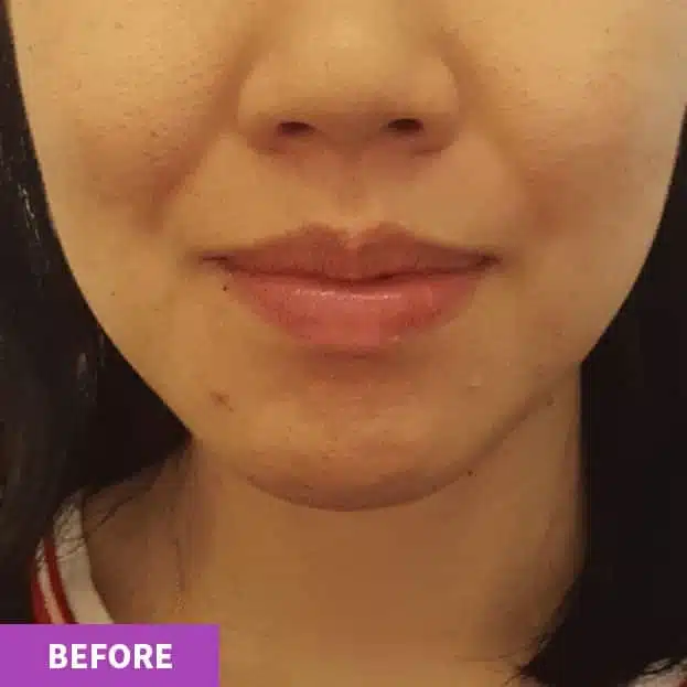Close-up of the lower half of a woman's face showing her lips and chin, highlighting her skin before an anti-ageing facial, with the word "BEFORE" in a purple box at the bottom left corner.