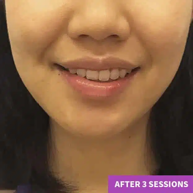 A close-up of the lower half of a woman's face, smiling softly after an anti-ageing facial. Text in the bottom right corner reads "AFTER 3 SESSIONS.