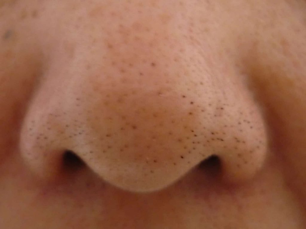 blackheads on nose