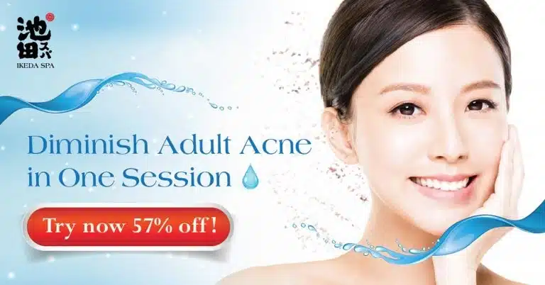 A smiling woman with clear skin is featured next to text promoting an Ikeda Spa adult acne treatment with a 57% discount offer.