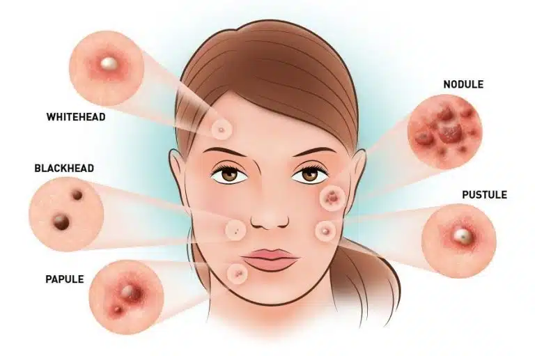 Illustration of a woman's face with labelled types of acne: whitehead, blackhead, papule, pustule, and nodule—highlighting how adult acne can appear, with close-up examples of each type.