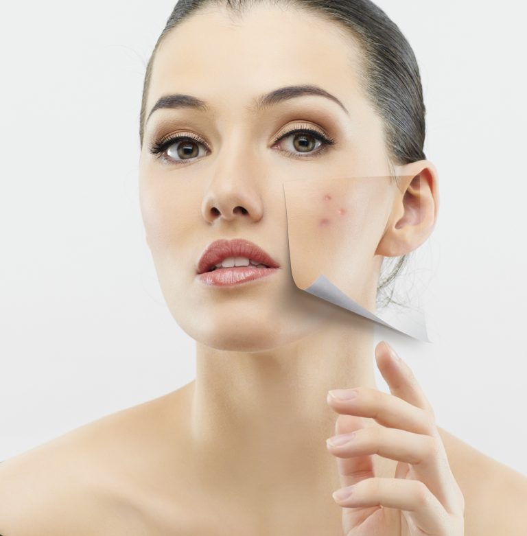 Adult Acne: 3 Effective Ways To Bid Goodbye!