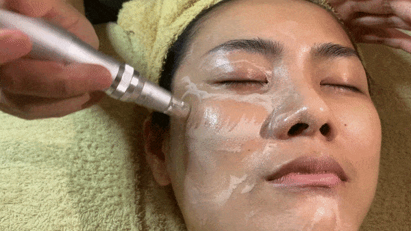 bb-glow-treatment-milia-seed-removal-facial-promotion-ikeda-spa-treatment-feature