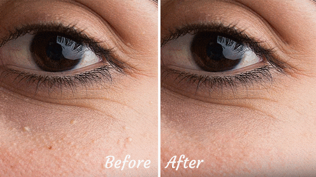 bb-glow-treatment-milia-seed-removal-facial-promotion-ikeda-spa-before-after