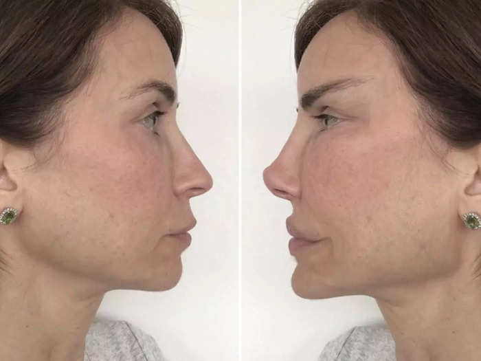 Frozen Face Botox