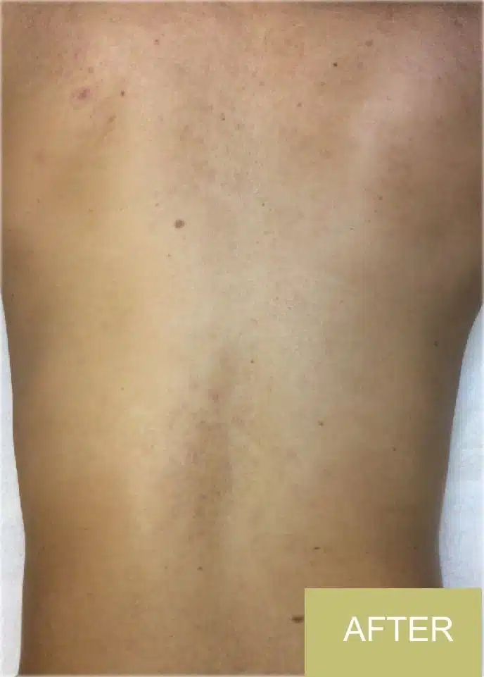 A person's bare back with minimal blemishes or discolouration, displaying clearer skin after back acne treatment. A label in the corner reads "AFTER.