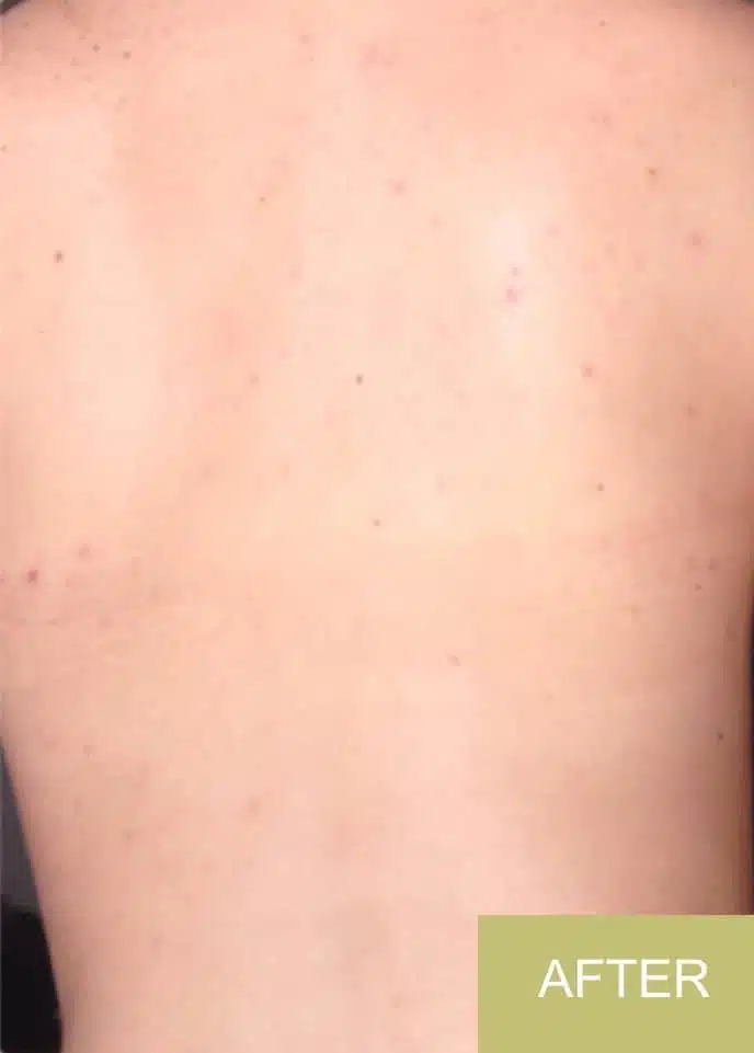 A person's bare back with minimal blemishes and clearer skin after using a back acne treatment, labelled "AFTER" in the bottom right corner.