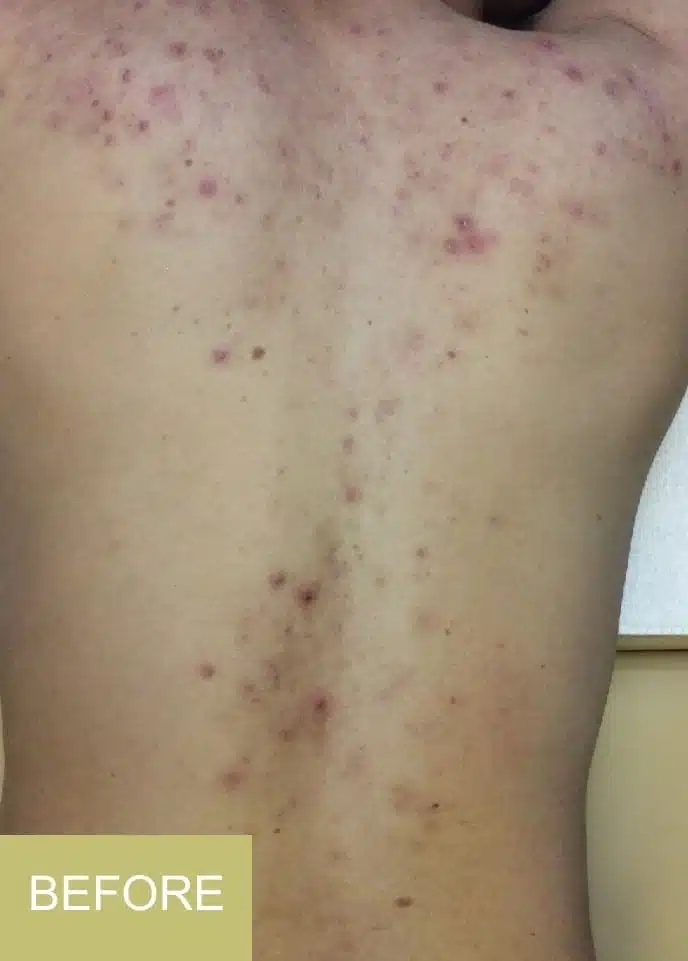 A person's bare back with numerous red and inflamed acne spots, highlighting the need for back acne treatment. The word "BEFORE" is shown in a box at the bottom left corner.