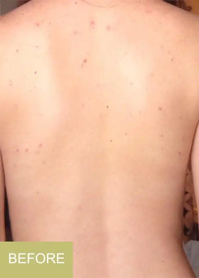 A person’s bare back with visible acne spots and blemishes, highlighting the need for back acne treatment. The word “BEFORE” appears in a green box at the bottom left corner.
