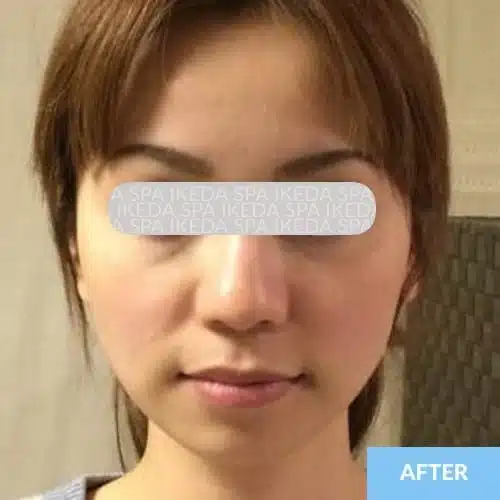 A woman with short brown hair faces the camera with a neutral expression, highlighting the results of Small Face Correction. The word "AFTER" is in a blue box at the bottom right, and her eyes are obscured by a label.