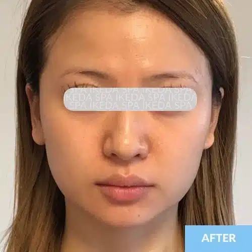 A woman with straight light brown hair faces forward; her skin appears smooth, and the image, labelled "AFTER" in the bottom right corner, suggests visible results from Small Face Correction.