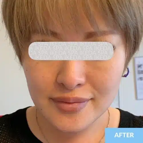 A person with short, light brown hair and fair skin is facing the camera. The eyes are obscured, and a blue label in the corner reads "AFTER," indicating the result following Small Face Correction.