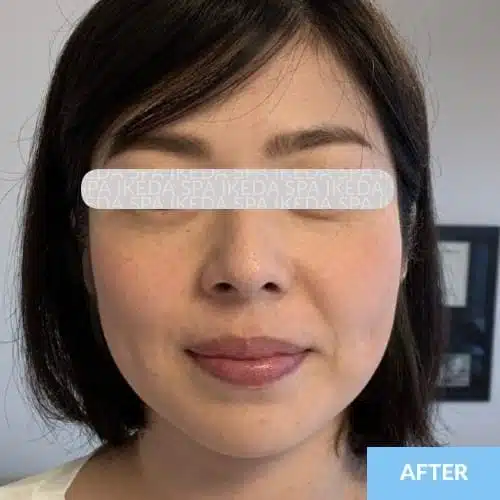 A woman with short dark hair is facing the camera, showing smooth skin and a slight smile. The image is labelled "AFTER" in the bottom right corner, highlighting the results of Small Face Correction.