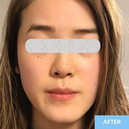A woman with long brown hair is facing the camera with minimal expression; her eyes are obscured by a label; "AFTER" text appears in the bottom right corner, indicating results after Small Face Correction.