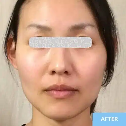 A woman’s face is shown facing forwards with minimal expression, suggesting the results of Small Face Correction. A label at the bottom right reads "AFTER." Eyes are obscured by a translucent overlay with repeated text.