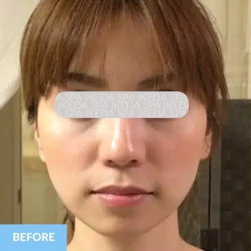 A woman with straight brown hair and clear skin is shown facing forwards; the word "BEFORE" appears in a blue box at the bottom left, indicating this is her appearance prior to Small Face Correction.