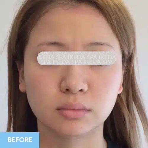 A woman with light brown hair looks straight at the camera with a neutral expression; "BEFORE" label is in the bottom left corner, illustrating her appearance prior to Small Face Correction.