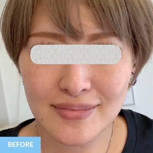 A woman with short, light brown hair and clear skin faces the camera, labelled "BEFORE" in the lower left corner. A grey overlay covers her eyes, suggesting a Small Face Correction may be shown in the next image.