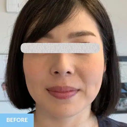 A woman with straight, chin-length dark hair is facing the camera with a neutral expression. The word "BEFORE" appears in a blue box at the bottom left. Eyes are obscured for privacy. Image shown prior to Small Face Correction.