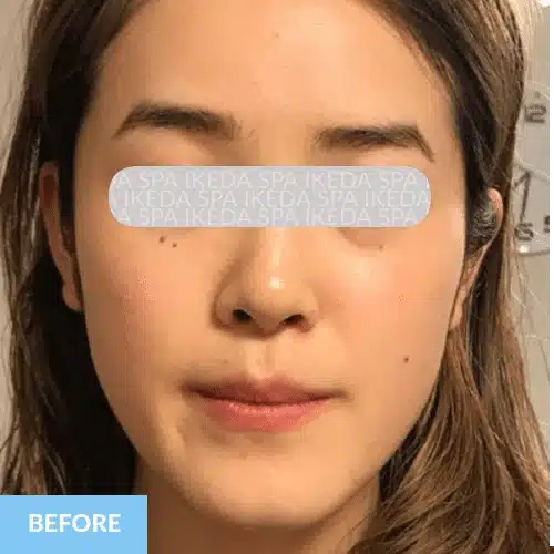 A woman with straight brown hair faces forwards, showcasing the effects of Small Face Correction. The word "BEFORE" is in a blue box at the bottom left, whilst her eyes are covered by a semi-transparent label.