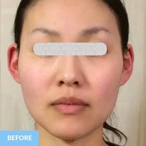 A woman with straight dark hair facing forward, her eyes obscured by a translucent label. A "Small Face Correction" and "BEFORE" label appear in the bottom left corner.