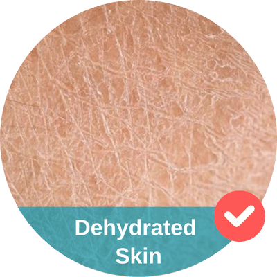 Dehydrated skin