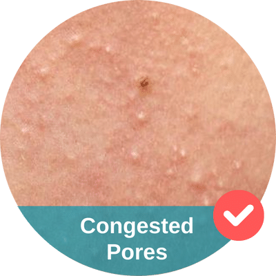 Congested pores