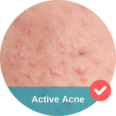 Active acne on a person's facial.