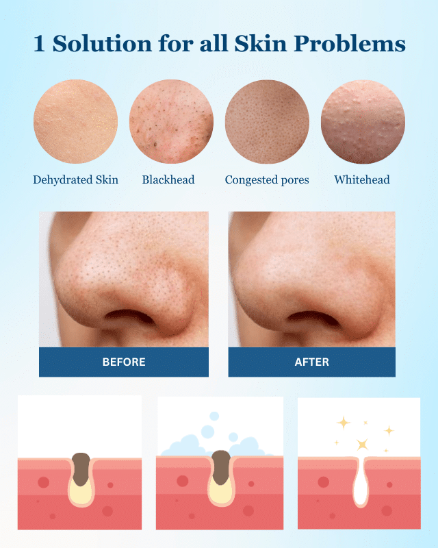 A diagram demonstrating effective techniques for removing acne and blackheads, with a focus on promoting healthy facial skin.