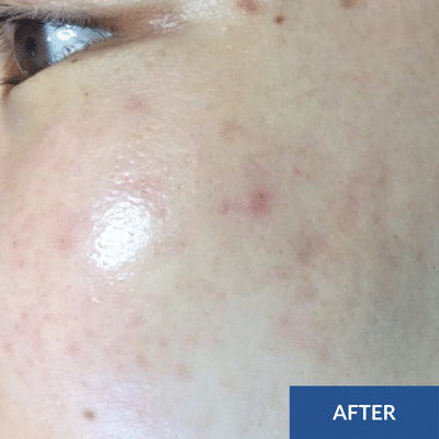 Close-up of a person's cheek reveals the rejuvenating effects of a hydrafacial, showcasing noticeably reduced acne and smoother skin, with just a few remaining red blemishes. Text in the corner reads "AFTER.