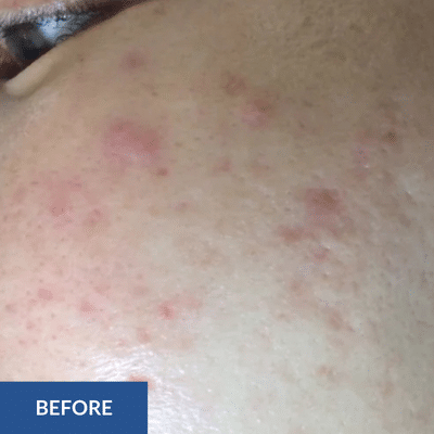Close-up of a person's cheek with red acne spots and blemishes, labeled "Before" in the bottom left corner, highlighting the need for a transformative hydrafacial.