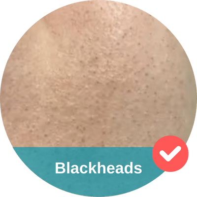 Close-up of skin with numerous blackheads and a label that reads "Hydrafacial Blackheads" with a checkmark icon.