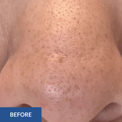 Close-up image of a nose with visible blackheads, labeled "Before" in the bottom left corner, highlighting the need for a hydrafacial.
