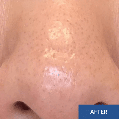 Close-up of a person's nose with a smooth, hydrated surface, featuring small pores visible after a hydrafacial treatment. A label on the bottom right corner reads "AFTER.