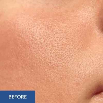 Close-up of skin with visible pores on the cheek, labeled "Before," reveals a complexion in need of a hydrafacial transformation.