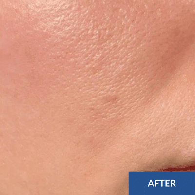 Close-up of smooth skin on a cheek, revealing the rejuvenating effects of a hydrafacial, with an "After" label at the bottom right corner.