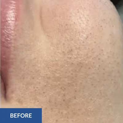 Close-up of a person's skin with visible pores and texture, labeled "Before hydrafacial" in the bottom-left corner.
