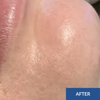 Close-up of a cheek with smooth skin, showing an "AFTER" text label in the corner, highlighting the rejuvenating effects of a Hydrafacial.