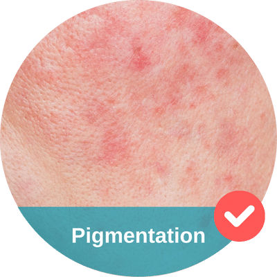 Close-up of skin with red pigmentation spots, overlaid with a teal label reading "Pigmentation" and a check mark icon, suggesting the benefits of a hydrafacial treatment.