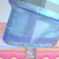 Close-up of a blue ice roller being applied to skin, showing a cross-section with layers and textures.