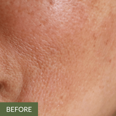 Close-up view of skin, highlighting pores and texture, reminiscent of an onsen facial. The word "before" is in the bottom left corner.