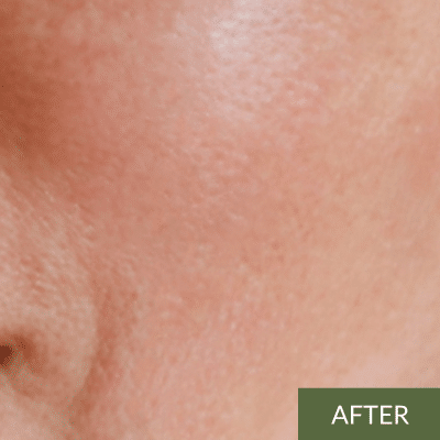 Close-up of a person's skin with a smooth complexion, reminiscent of an onsen facial glow. A small portion of the eye and cheek is visible, with the word "AFTER" in the bottom right corner.