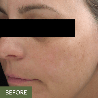Close-up of a person's face before an onsen facial treatment, highlighting the natural light freckles and skin texture. Eyes are covered with a black bar for anonymity.