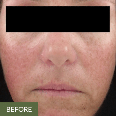 Close-up of a person's face, showcasing skin pigmentation and freckles. The eyes are obscured by a black rectangle. At the bottom left corner, a label reads "BEFORE," hinting at the transformation an onsen facial might bring.