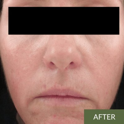 Close-up of a person's face with a neutral expression, eyes obscured by a black bar. The image, evoking the tranquility of an onsen facial, is labeled "AFTER" in the bottom right corner.