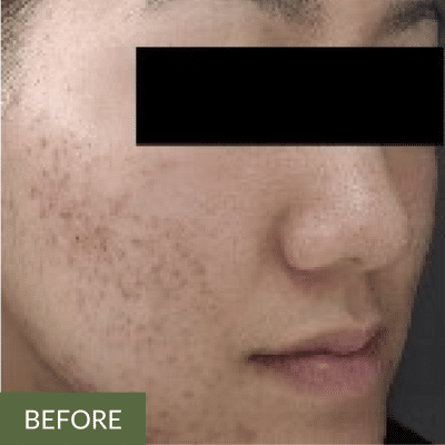 Close-up of the lower half of a person's face with visible acne scars and blemishes on the cheek, suggestive of needing an onsen facial. The eyes are covered with a black bar. "BEFORE" is labeled in the bottom left corner.