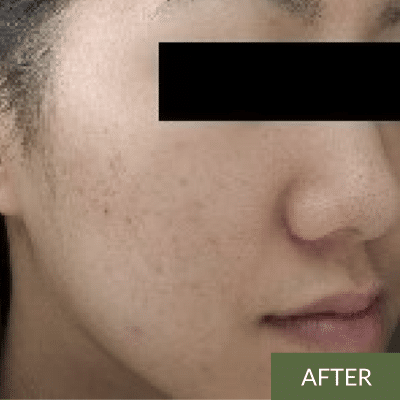 Close-up of a person's cheek with clear skin, showcasing the rejuvenating effects of an onsen facial. A few visible pores and freckles add character, while the word "AFTER" is displayed in the bottom right corner. Face is partially obscured with a black bar.